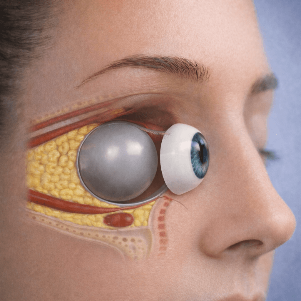 Anophthalmos